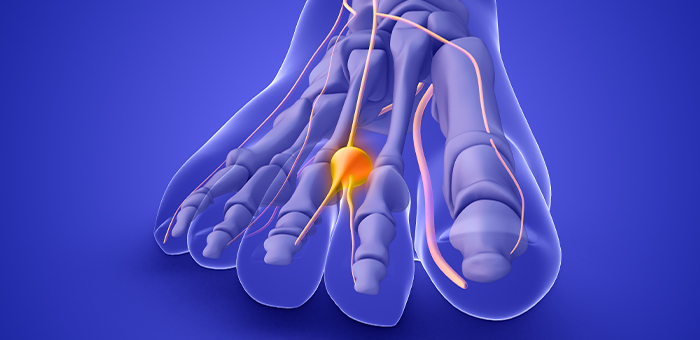 Patient suffering from Diabetic Neuropathy in need of chiropractor in Back Pain, Neck Pain & Headache Relief Center of Bakersfield